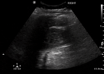 https://www.aliem.com/wp-content/uploads/1-Right-Moderate-Hydronephrosis.gif