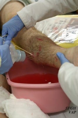 Fx Tib Fib Open Irrigation open fractures antibiotics