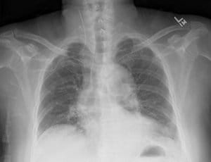 CXR_Subclavian