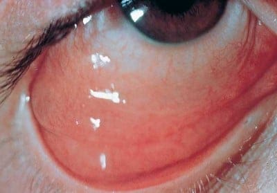 BacterialConjunctivitis