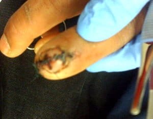 Fingernail Lac