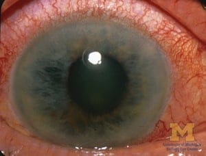Glaucoma