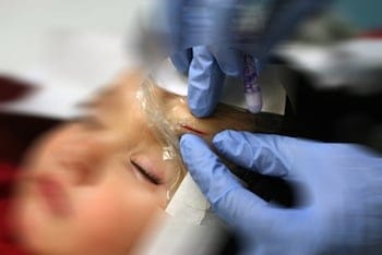 Dermabond Tape