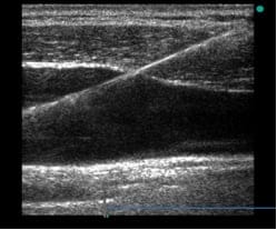 IJ ultrasound