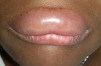 Angioedema Lip