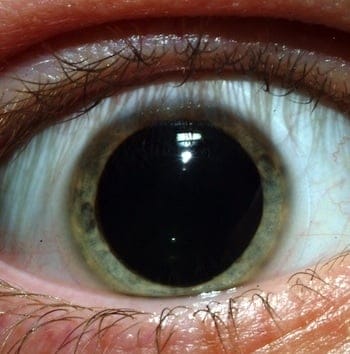 DilatedPupilsm