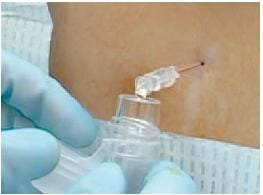 Lumbar Puncture