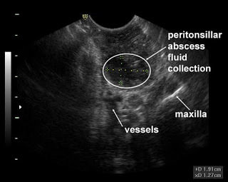 peritonsillar abscess ultrasound
