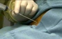 Paracentesis