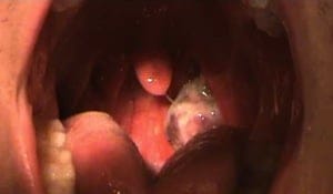 Strep