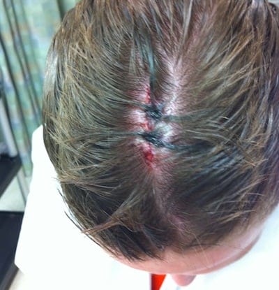 scalp laceration