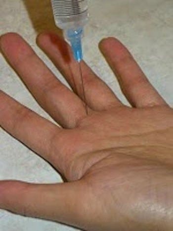Digital Volar Injection