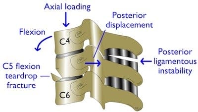 Fig9E Fx FlexTear anatomy cervical spine fracture