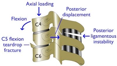 cervical fractures diagram