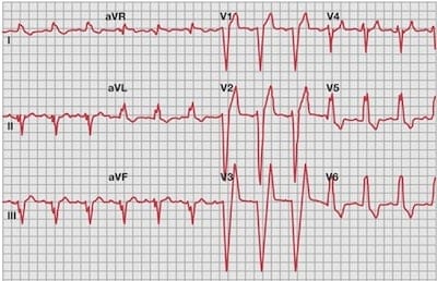 EKG_LBBB