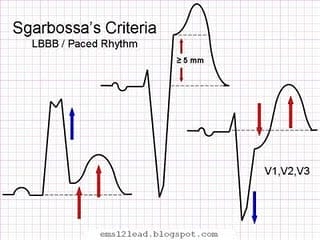 Sgarbossa criteria