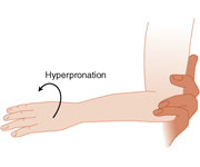 Image result for hyperpronation nursemaid elbow