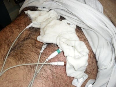 EKG leads hairy chest