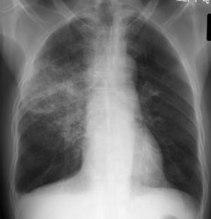 Pneumonia RUL CXR