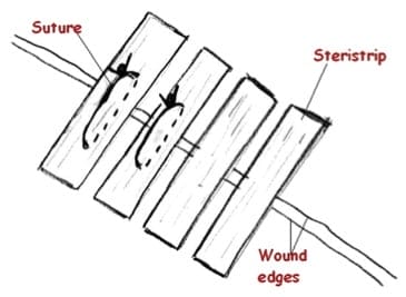 SteriSutureFig1