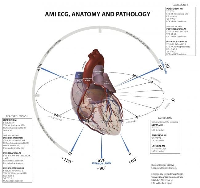 ECG anatomy illustration AMI