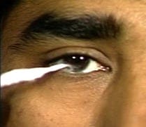 Cornealreflex