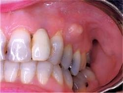 Periapical Abscess