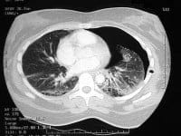 Pneumothorax CT