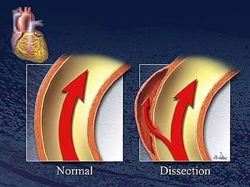 Aortic Dissection