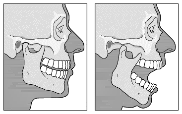 Temperomandibular (TMJ) dislocation