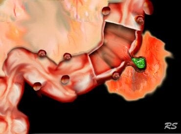 diverticulitis