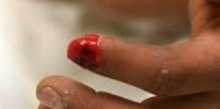 FignernailGone2sm fingertip injuries