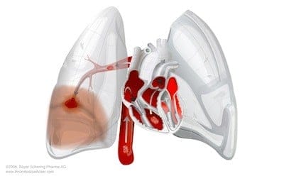 Pulmonary embolism prediction tools