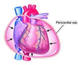 cardiac tamponade