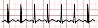 Sinus Tachycardia