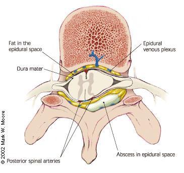 Spinal epidural abscess anatomy illustration