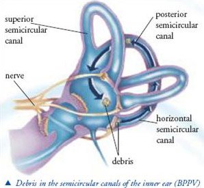BPPV Epley maneuver inner ear