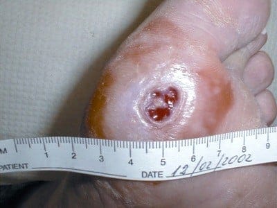 diabetic foot ulcer