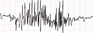 EKGtremor