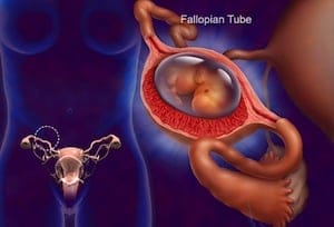 Ectopic Pregnancy