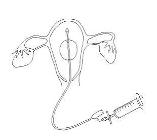 foley catheter
