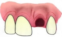 ToothAvulsion