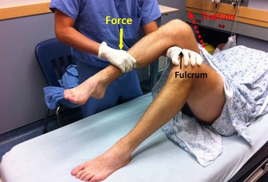 Hip dislocation