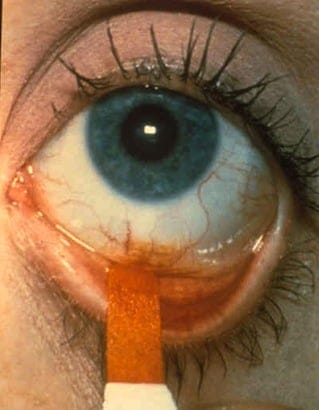 Fluorescein Strip Eye