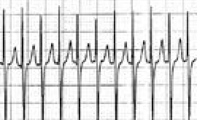 Tachycardia_ECGtracing