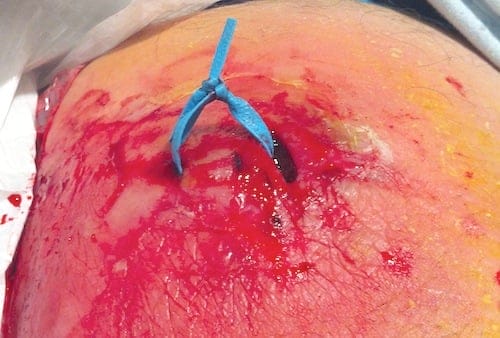 AbscessILD