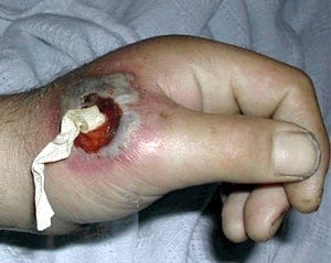 Abscess Packing Hand