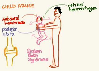 Child abuse injury patterns