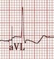 Reciprocal Change in aVL