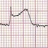 STEMI